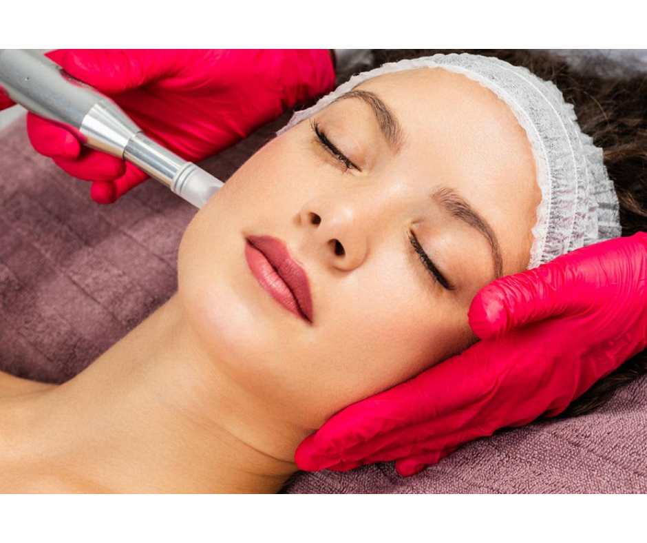 Microneedling treatment stimulating collagen production to improve skin texture, tone, and overall skin rejuvenation