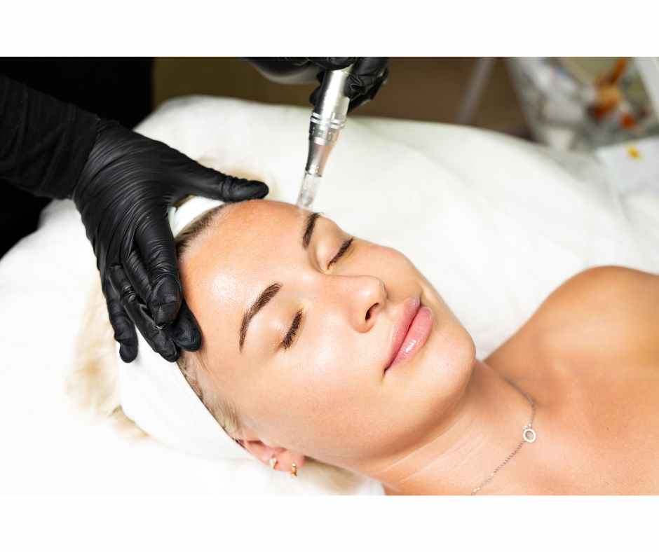 Microneedling treatment for acne and acne scars showing controlled dermal stimulation to support collagen remodeling and improve skin texture